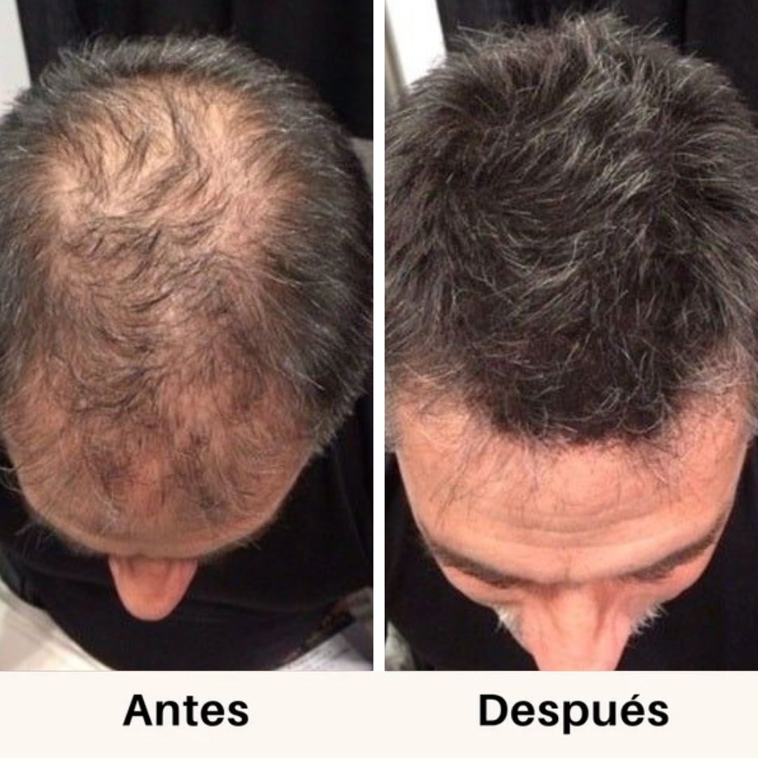 Simpli™ Hair Growth